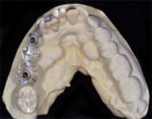 Surgical stent 